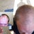 Hair Transplant Community Photo