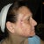 Microdermabrasion Community Photo
