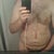 Male Tummy Tuck Community Photo