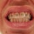 Braces Community Photo