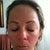 Photodynamic Therapy Community Photo