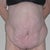 Thigh Lift Community Photo