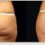Butt Implants Community Photo