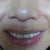 Scar Removal Community Photo
