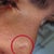Mole Removal Community Photo