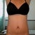 Tummy Tuck Revision Community Photo