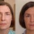 Brow Lift Community Photo