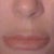 Lip Lift Community Photo