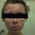 Acne Treatment Community Photo