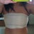 Breast Implant Removal Community Photo