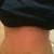 Mini Tummy Tuck Community Photo