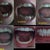 Braces Community Photo