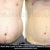 Liposonix Community Photo