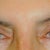 Brow Lift Community Photo