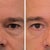 Eye Bags Treatment Community Photo