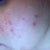 Glycolic Peel Community Photo