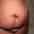 Panniculectomy Community Photo