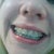 Damon Braces Community Photo