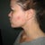 Glycolic Peel Community Photo