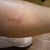 Sclerotherapy Community Photo