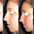 Non Surgical Nose Job Community Photo