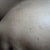 Acne Scars Treatment Community Photo