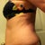 Liposonix Community Photo