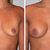 Top 10 Essentials to Getting the Best Breast Implants