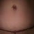 Tummy Tuck Revision Community Photo
