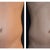 Liposculpture Community Photo