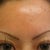 Glycolic Peel Community Photo