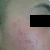 Acne Scars Treatment Community Photo