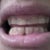Dental Crown Community Photo