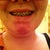 Damon Braces Community Photo