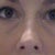 Eye Bags Treatment Community Photo