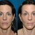 Brow Lift Community Photo