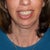 Chin Surgery Community Photo