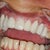 Dental Crown Community Photo