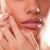 How To Get Rid Of Acne Scars