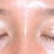 Asian Eyelid Surgery Community Photo