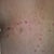 Laser Hair Removal Community Photo