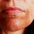Chemical Peel Community Photo