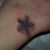 Tattoo Removal Community Photo
