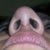 Nose Surgery Community Photo