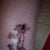 Tattoo Removal Community Photo