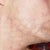 Laser Hair Removal Community Photo