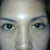 Asian Eyelid Surgery Community Photo