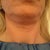 Neck Lift Community Photo