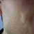 Acne Scars Treatment Community Photo