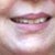 Lip Implants Community Photo